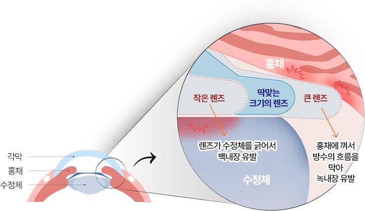 작은 렌즈 - 렌즈가 수정체를 긁어서 백내장 유발, 큰 렌즈 - 홍채에 껴서 방수의 흐름을 막아 녹내장 유발