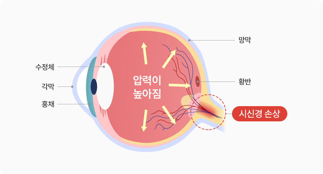 압력이 높아짐 > 시신경 손상