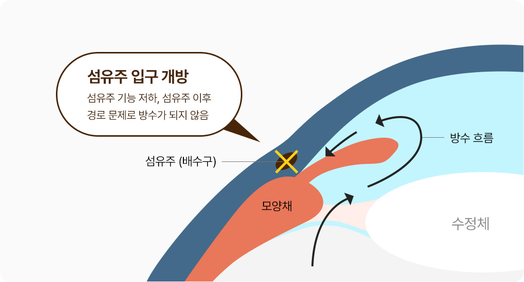 섬유주 입구 개방 - 섬유주 기능 저하, 섬유주 이후 경로 문제로 방수가 되지 않음