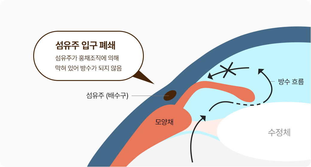 섬유주 입구 폐쇄 - 섬유주가 홍채조직에 의해 막혀 있어 방수가 되지 않음