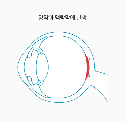 망막과 맥락막에 발생