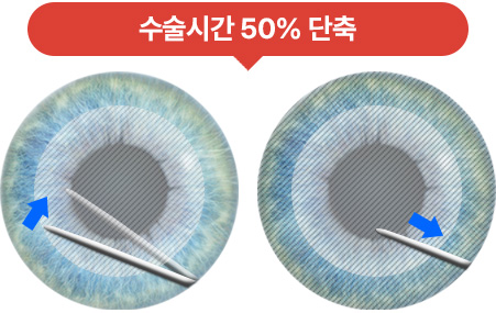 수술시간 50% 단축
