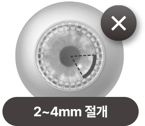 2~4mm 절개